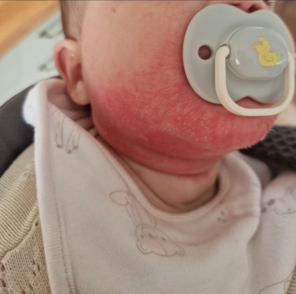 Mystery rash and furiously upset baby