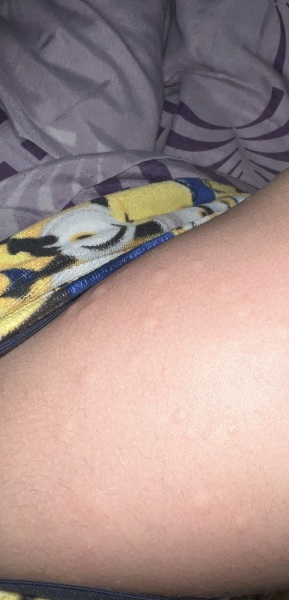 3am now and Ds woke up with weird colourless spot covering everywhere  (picture attached)