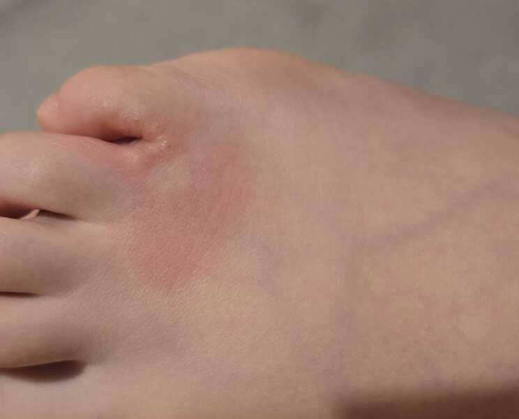 Cellulitis?
