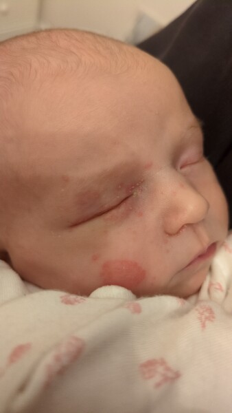 Newborn rash help