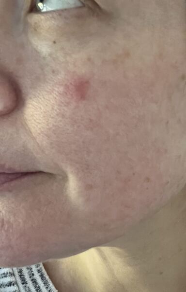 Has anyone had similar on their face. Is it skin cancer?