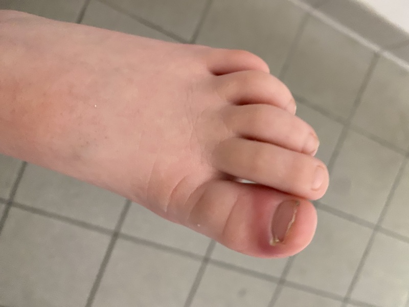 Infected toe - 111 job for a Sunday or wait til morning for GP?