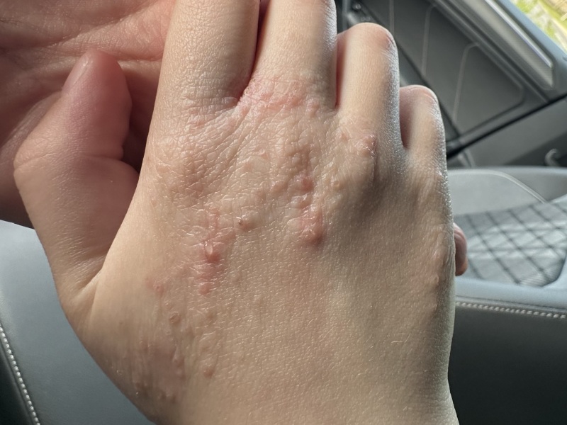 Does anyone suffer from dermatitis herpetiformis?