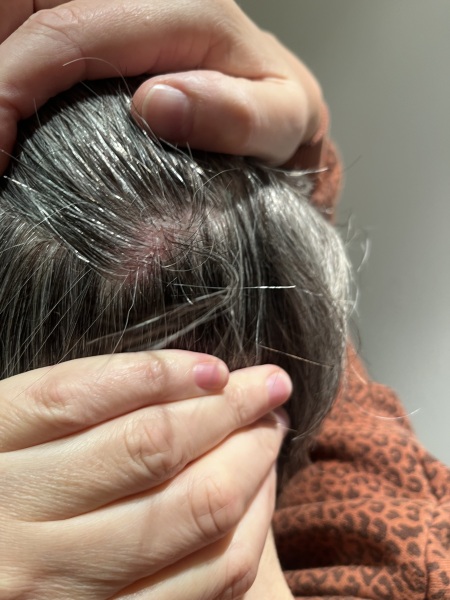 Any ideas what this sore red patch is on my scalp?
