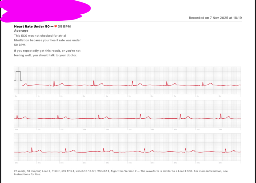 Pulse in 30s? How low is too low?