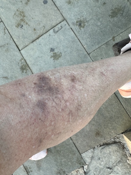 Leg veins / spider veins