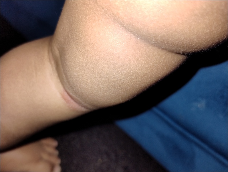 1 year old has developed red rash behind knees