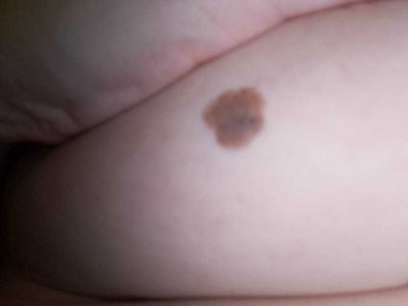 Melanoma?