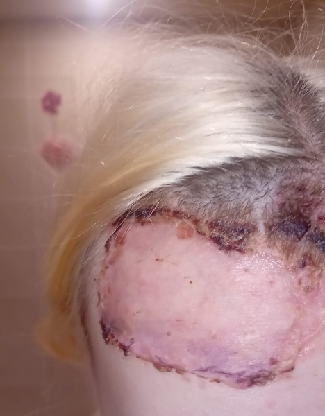 Daughter in hospital - full thickness burns