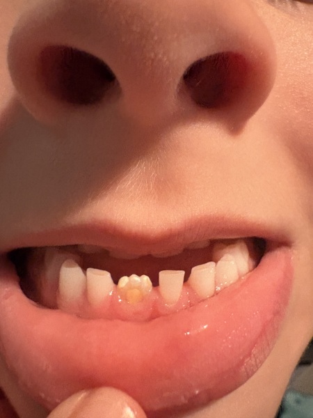 First adult tooth discoloured