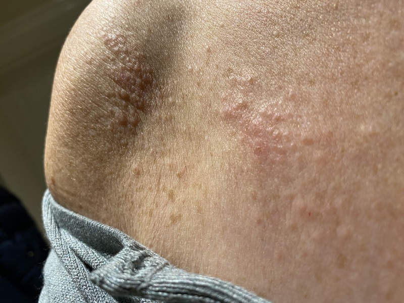 Does anyone suffer from dermatitis herpetiformis?