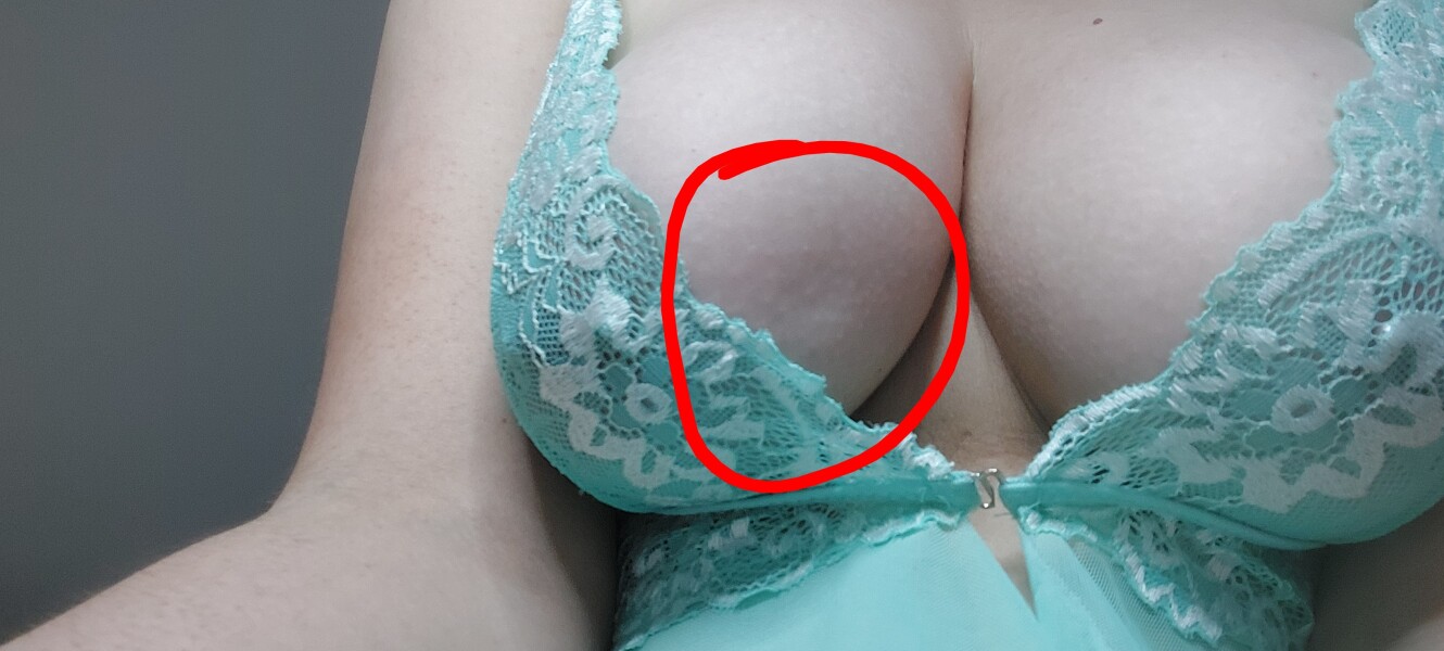 Worried I've got breast cancer