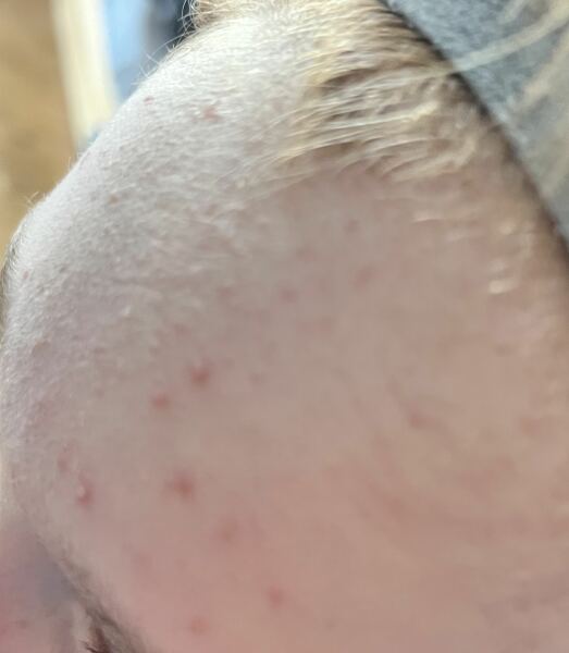 My son won’t let me at his spots