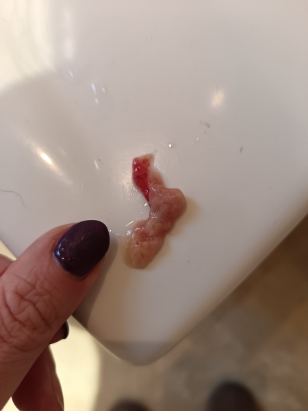 Blood-streaked hardened phlegm - gross photo