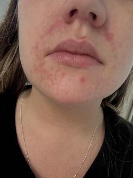 Perioral dermatitis