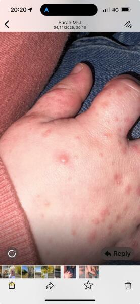 Chicken pox? (Pics attached)