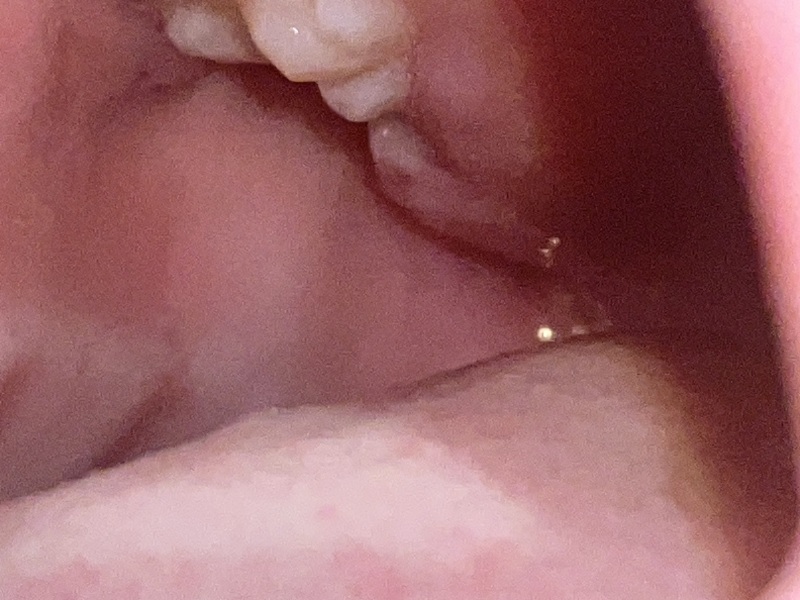 Is this dry socket?