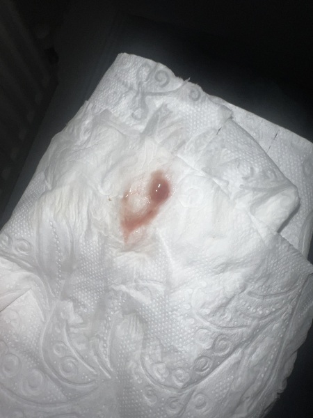 Ovulation bleeding? Tw PIC