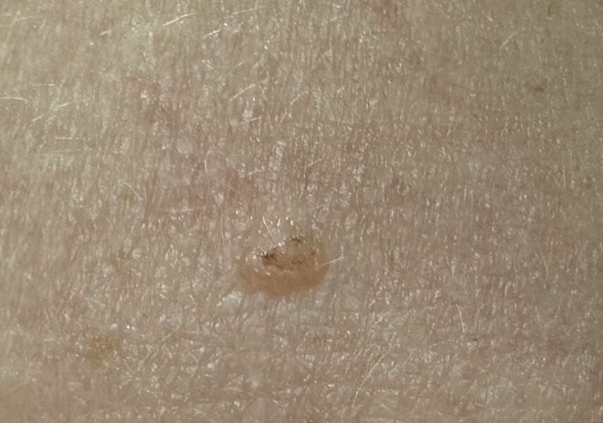 Do you think this mole is dodgy?