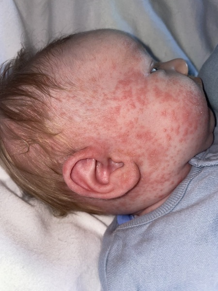 Newborn rash eczema or baby acne?