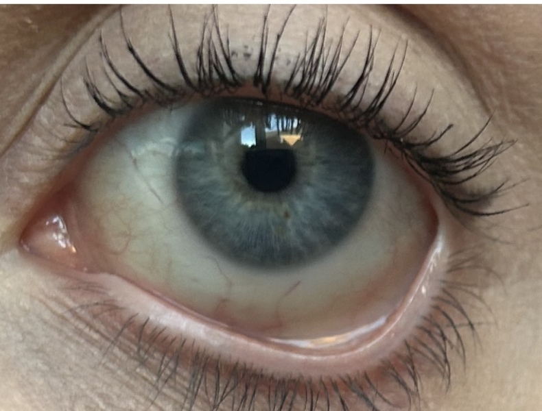 Are my eye whites are yellow?
