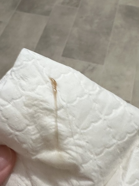 Bleeding in pregnancy