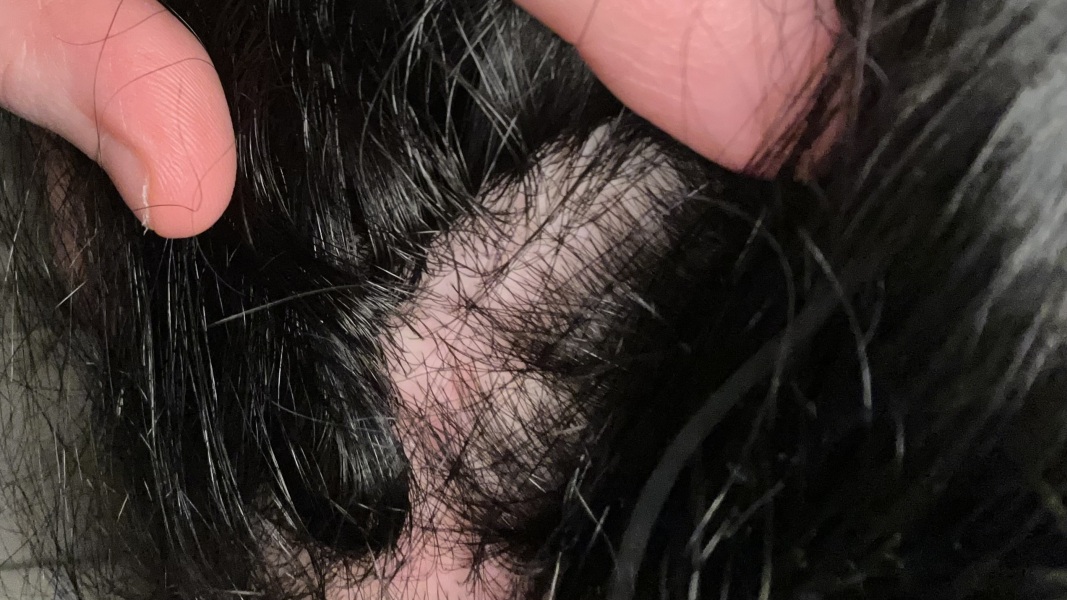 Is this normal postpartum hair loss?