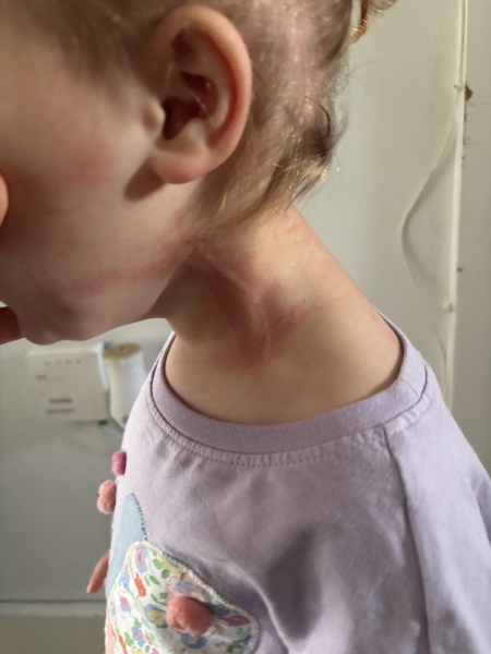 Hives for dairy allergy or something else?