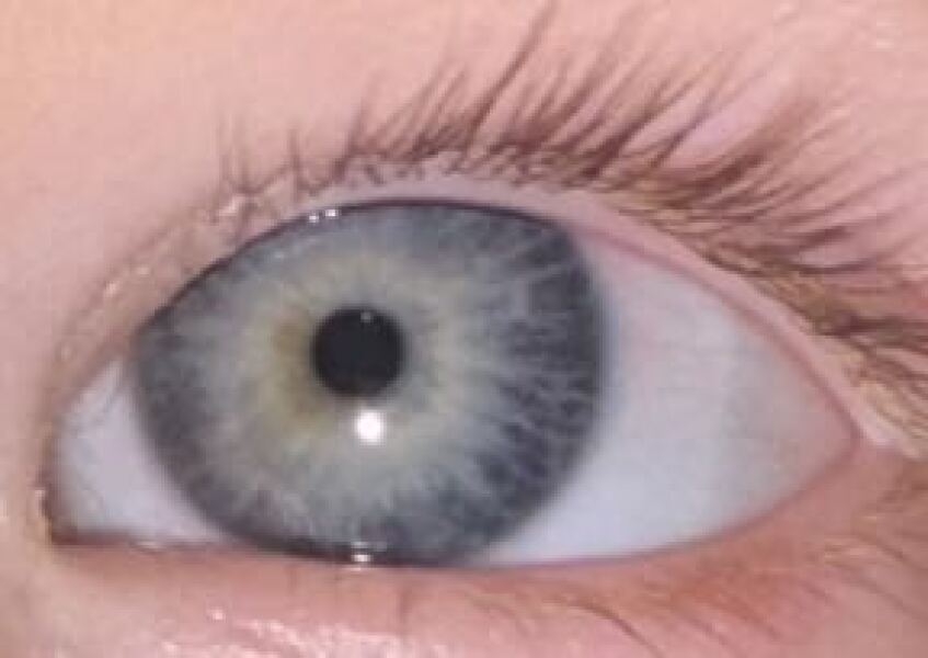 Change in toddler eye colour