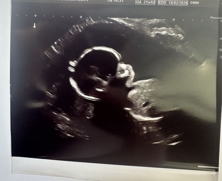 Hair on Ultrasound?