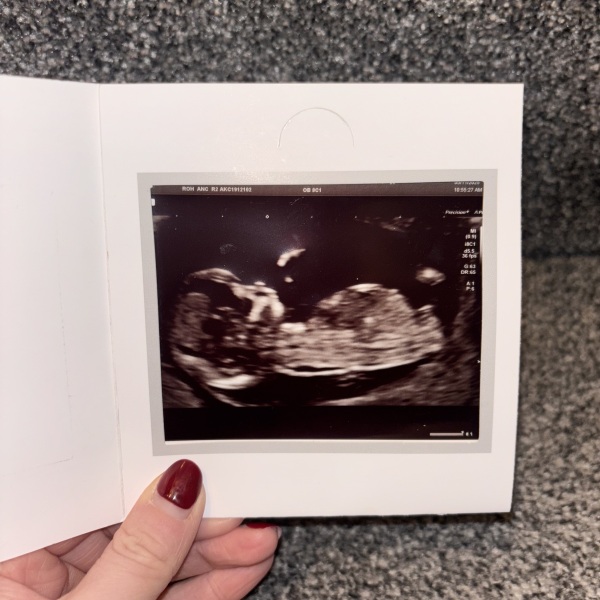 Babies sex based on ultrasound?