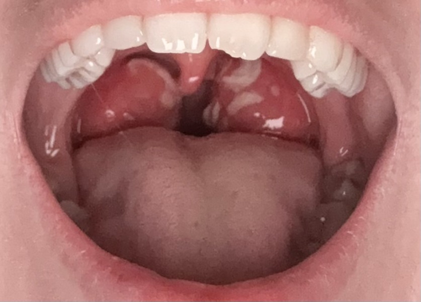 Severe Tonsillitis?!