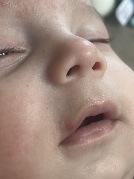 Cold sore or blister?