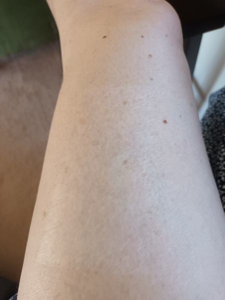 Daughter in hospital - full thickness burns