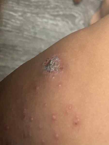 Do these chicken pox look normal ?