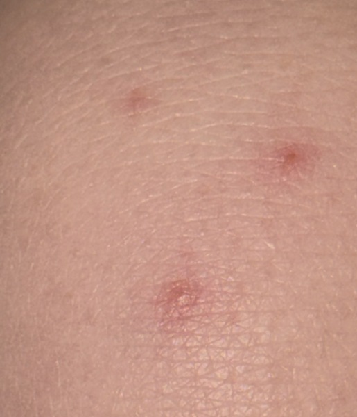 Possible Chickenpox’s