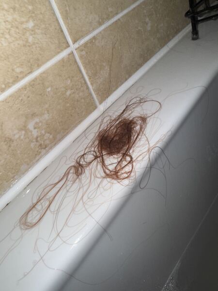Is this hair loss normal 5 months PP!!!! I am starting to worry