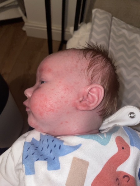 Newborn rash eczema or baby acne?
