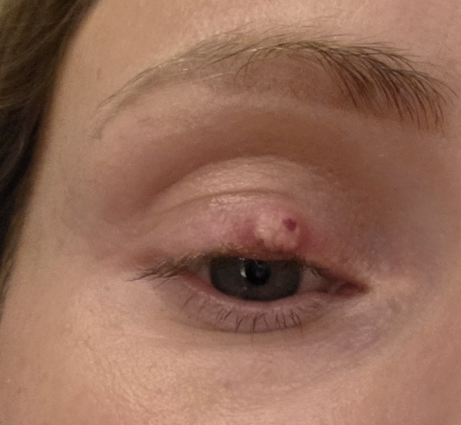 Large stye - how to encourage it to pop/reduce?