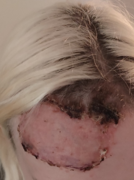 Daughter in hospital - full thickness burns
