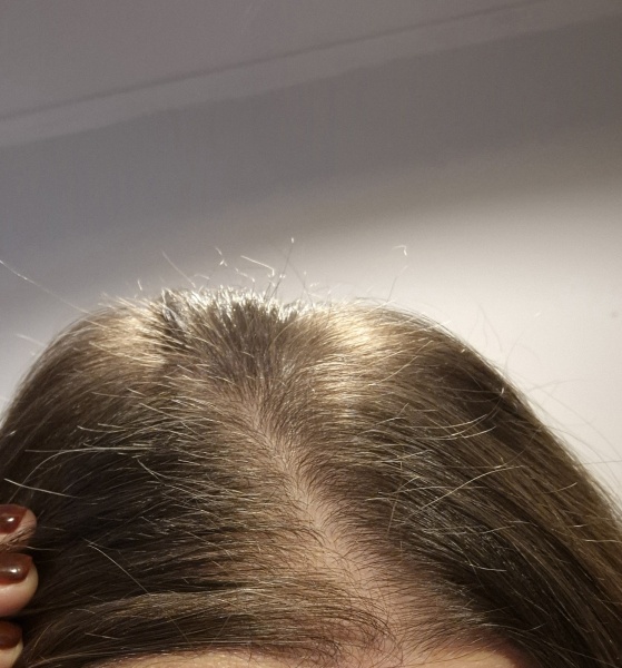 Hair regrowth
