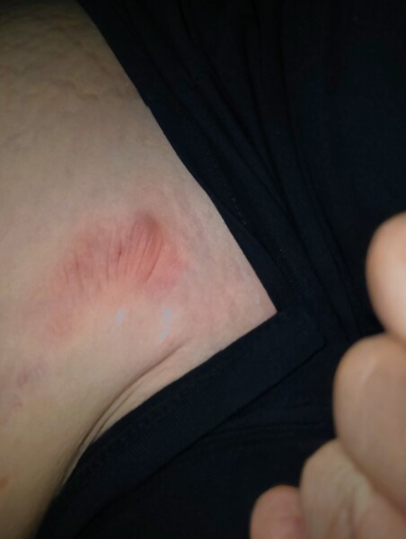 Help strange stretch mark bump underneath