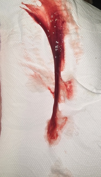 Bloody show? Picture attached (TW)