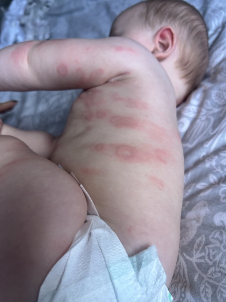 What on earth is this rash?! Drs don’t seem worried but it’s driving me mad!