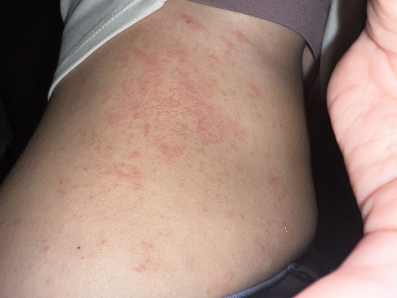 …to think this might not be eczema?