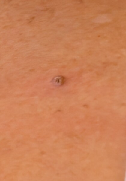 Skin lesion