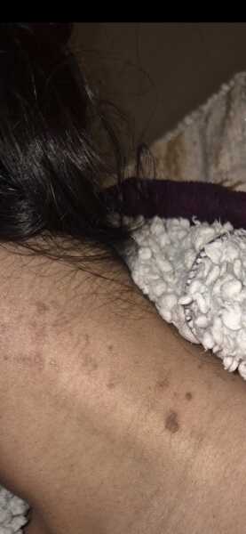 Unknown neck rash?!