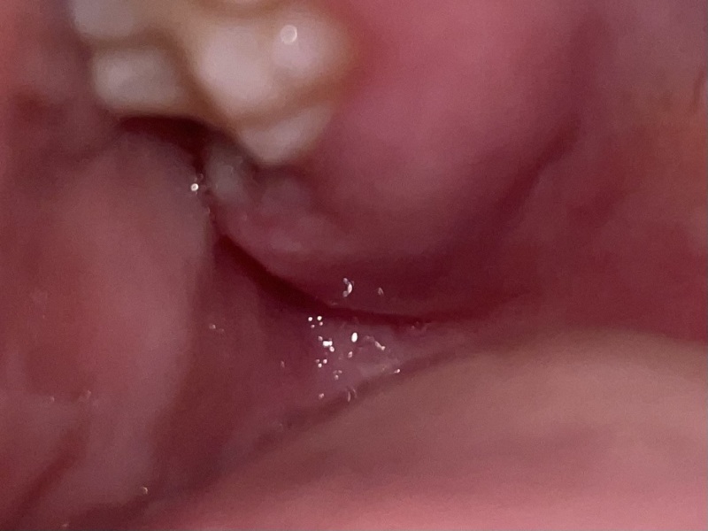 Is this dry socket?