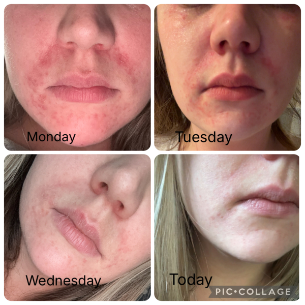 Perioral dermatitis