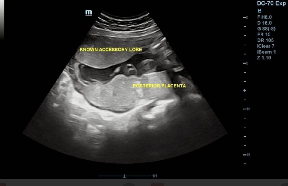 Extra placenta lobe and breech baby